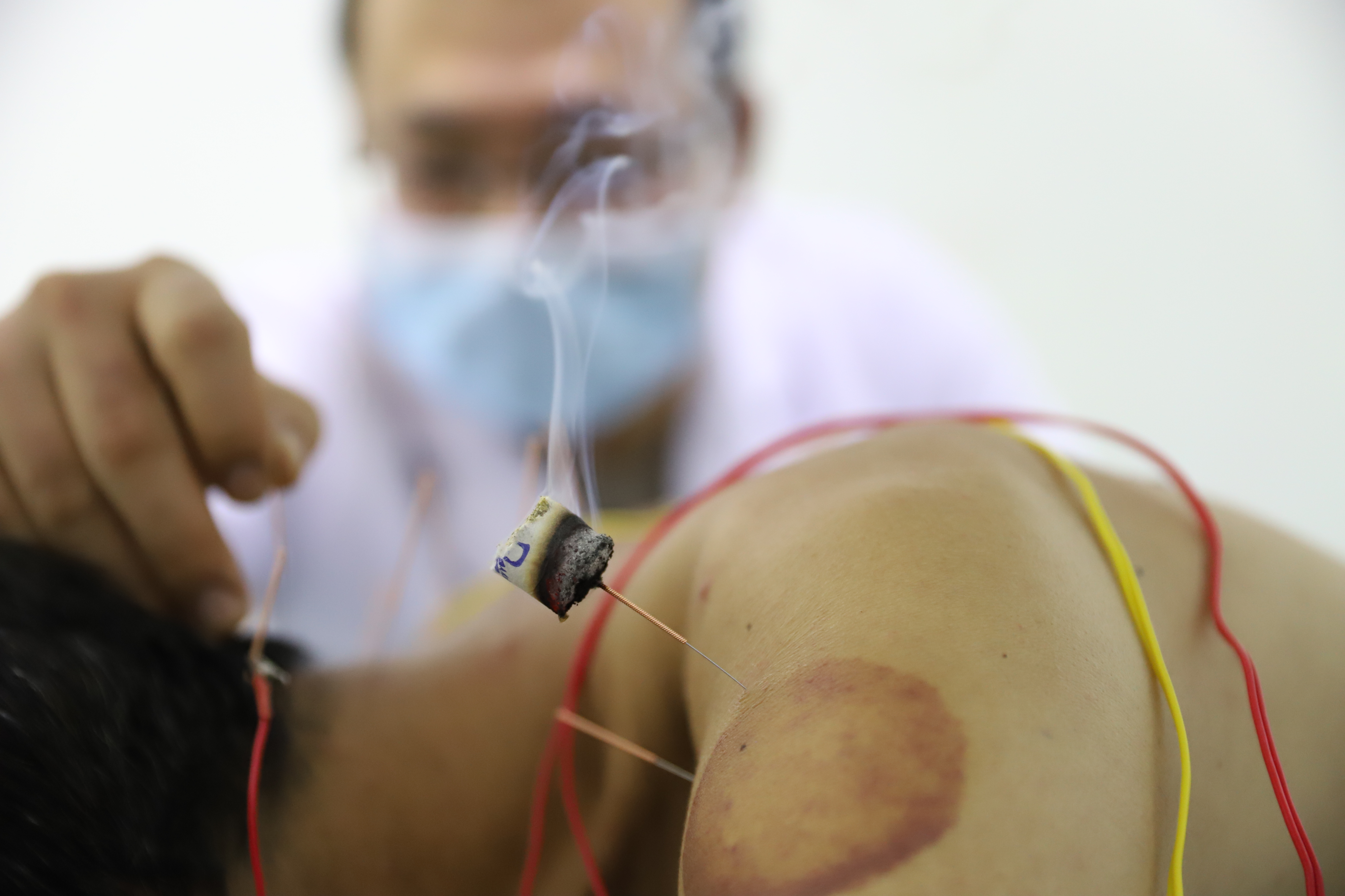 2020年12月15日,中心中医馆内,同事正在为一名患者作温针灸治疗.